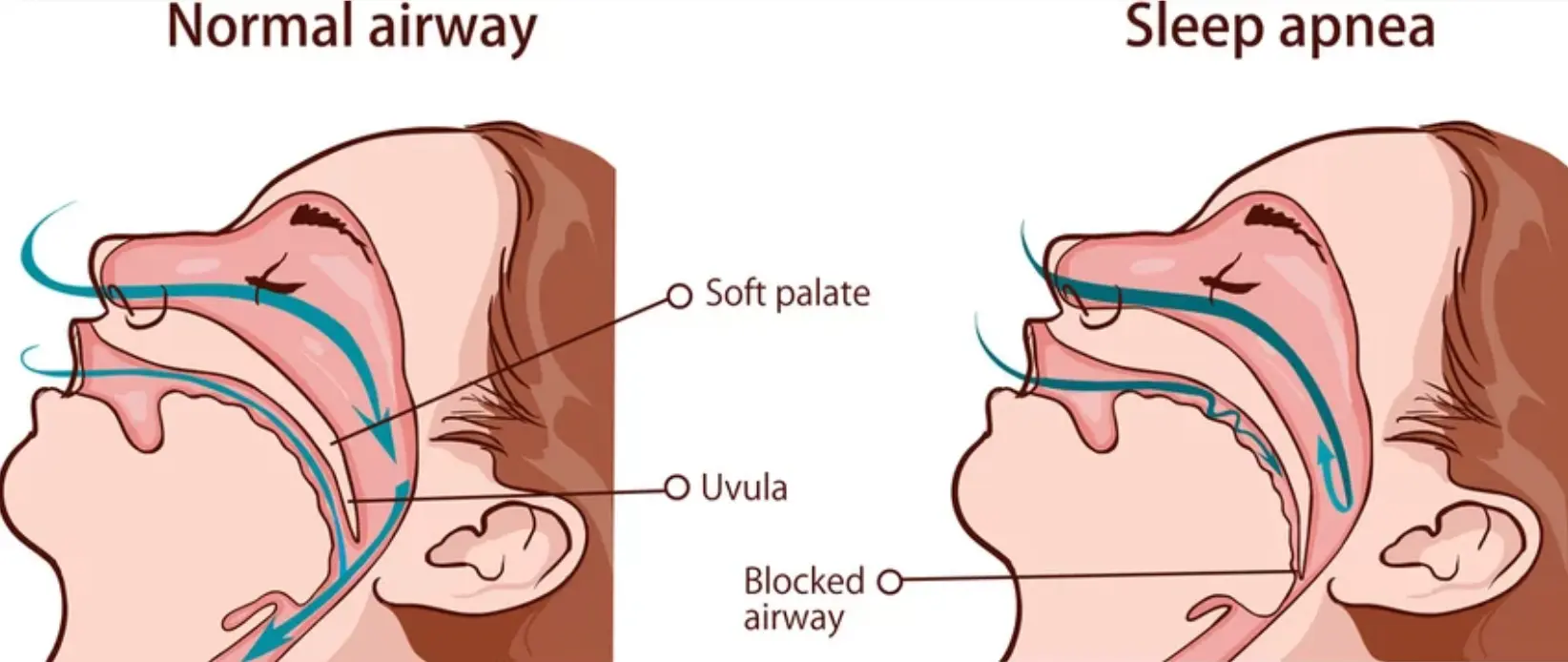 Sleep Apnea – Types, Causes and Symptoms